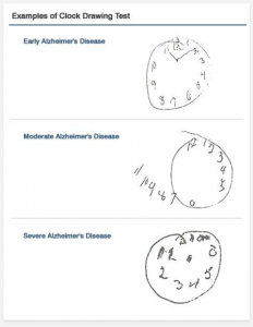 An example of how people with Alzheimer’s Disease perceive a clock face – this is  test which doctors use to assess the development of the disease. As it progresses, numbers leave the clock face altogether, and then appear in the wrong places. 
